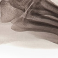 Recomendações ao paciente com dor nos pés e com o esporão no calcâneo